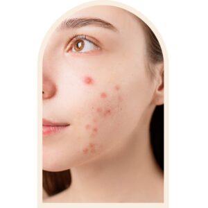 Sueroterapia Antiacné