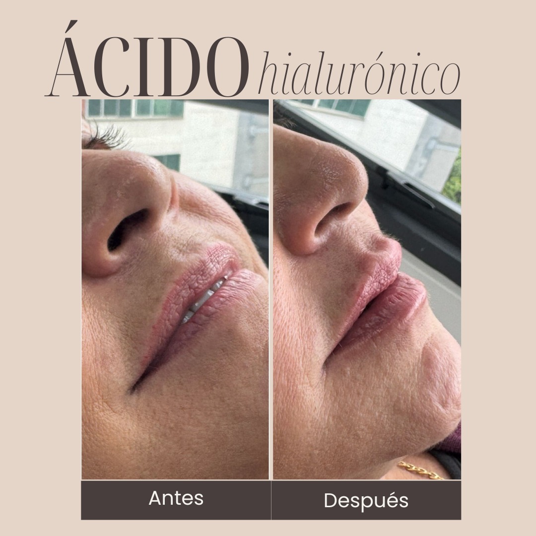 Acido Hialurónico - Imagen 3