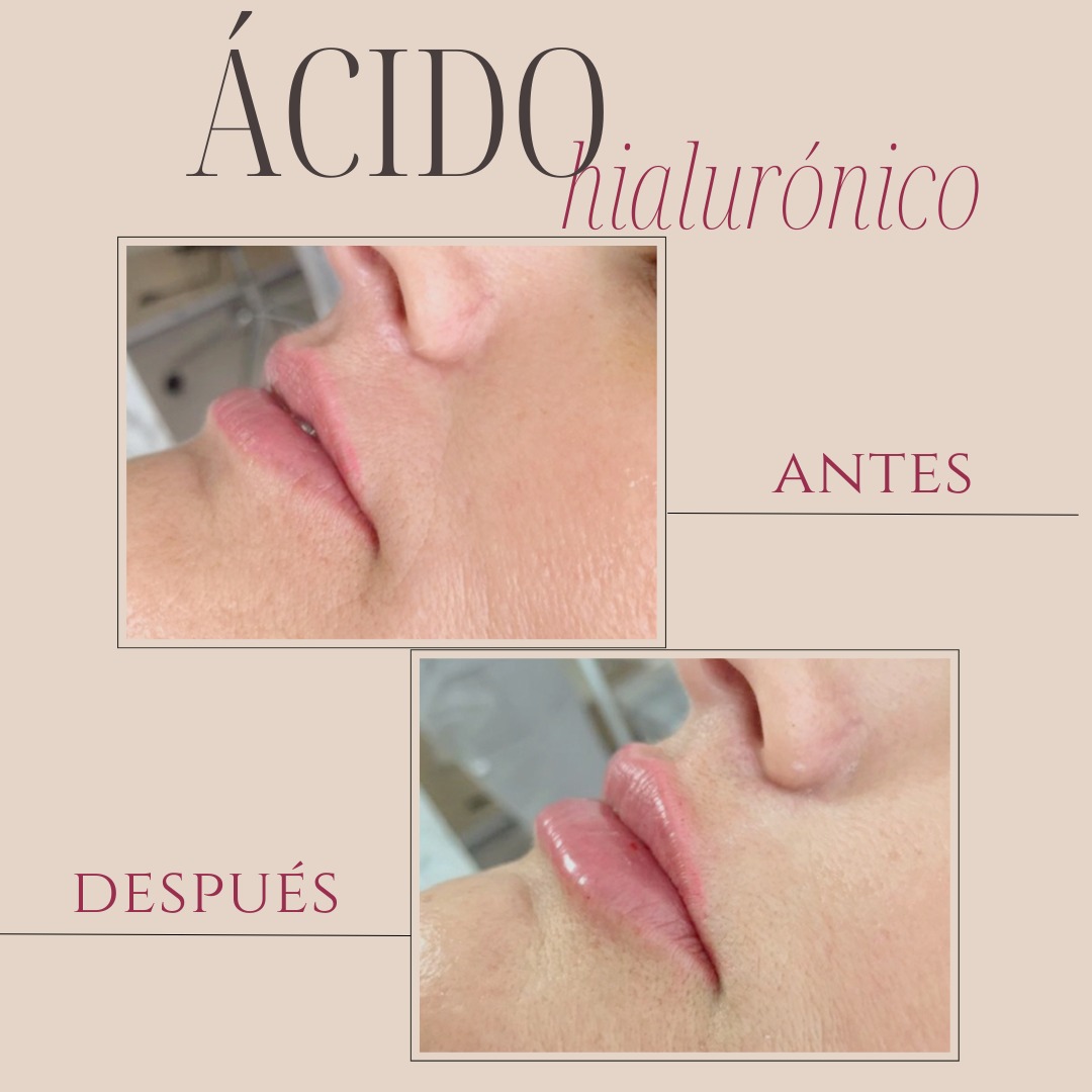 resultado tratamiento acido hialuronico