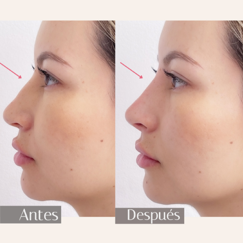 Antes y después de ácido hialurónico en Medellín