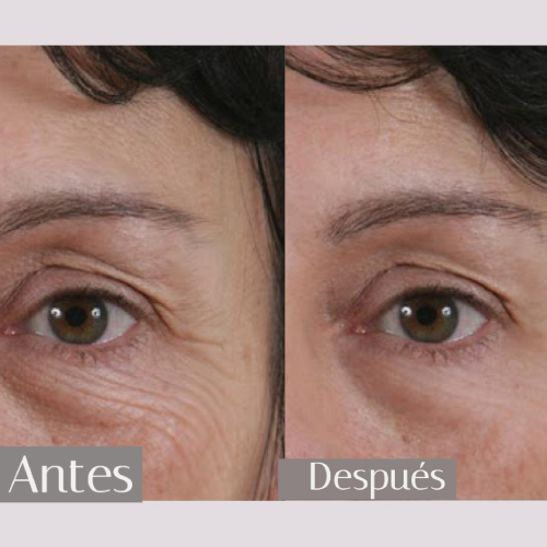 Antes y después de bioestimuladores faciales en Medellín