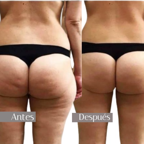 before and after Bye Bye Cellulite treatment at Senzzes