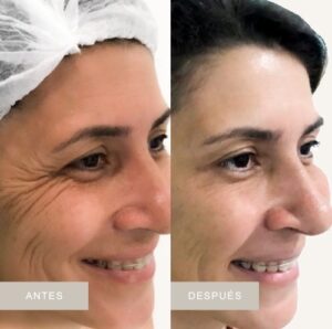 Antes y después de plan facial médico en Senzzes IPS