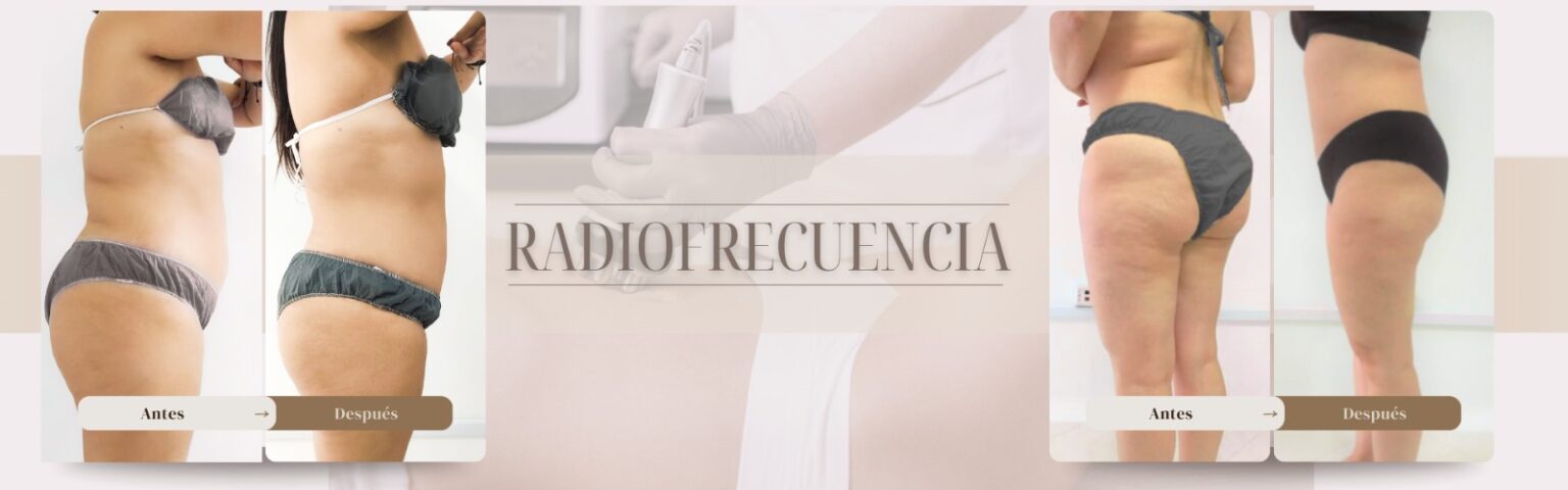 Antes y después de radiofrecuencia corporal en Senzzes IPS Medellín