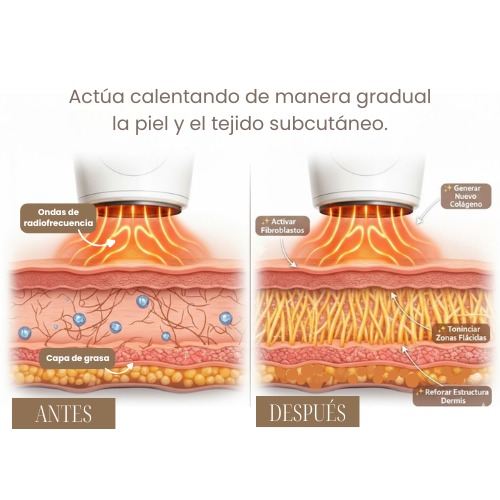 Funcionamiento de la radiofrecuencia corporal mostrando activación de fibroblastos y producción de colágeno en la dermis