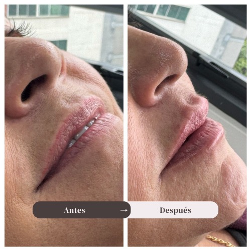 Resultado natural de relleno de labios con ácido hialurónico realizado en clínica estética en Medellín para mejorar forma y definición