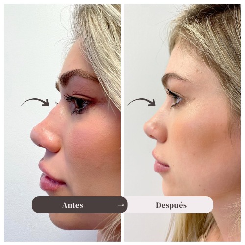 Resultados de tratamiento con ácido hialurónico en rostro y duración aproximada del efecto en procedimientos estéticos