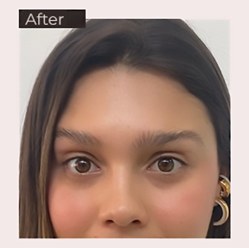 Natural-looking results after botulinum toxin treatment in Medellín with reduced expression lines