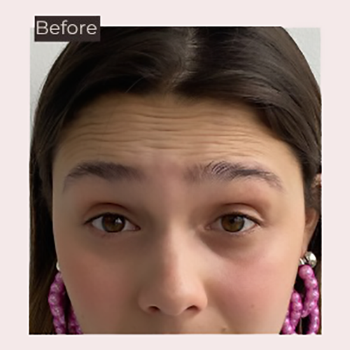 Before botulinum toxin treatment in Medellín for the reduction of expression lines
