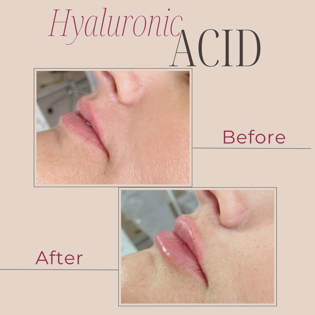 Hyaluronic Acid Treatment Results