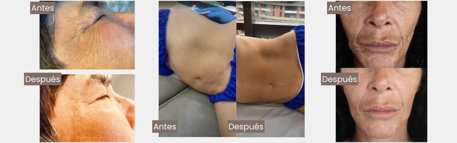 Bioestimulador de colágeno AESPLLA - Image 2