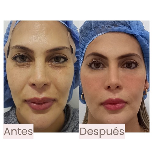 Before and after chin and jawline treated with facial harmonization