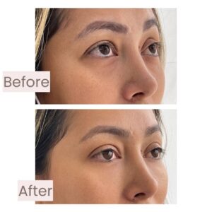 Before and after under-eye treatment with facial harmonization