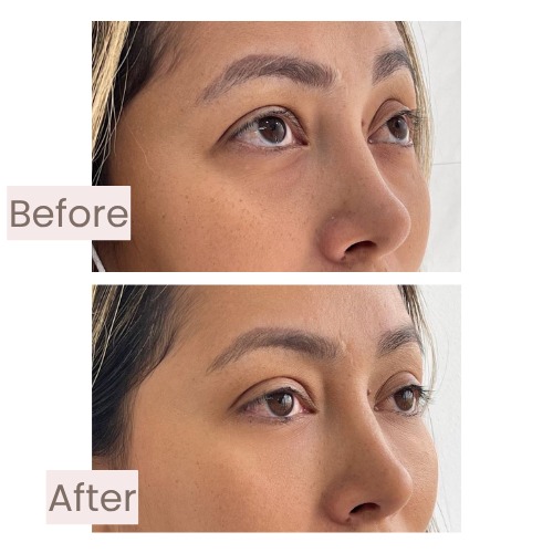 Before and after under-eye treatment with facial harmonization