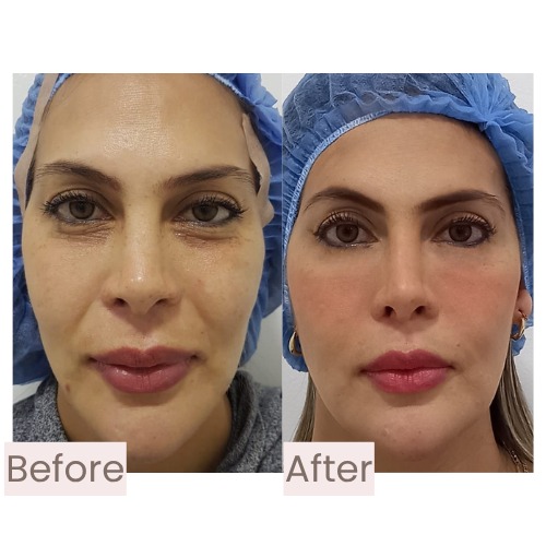 Before and after chin and jawline treated with facial harmonization