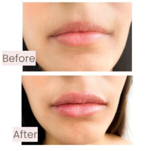 Before and after lip enhancement with facial harmonization