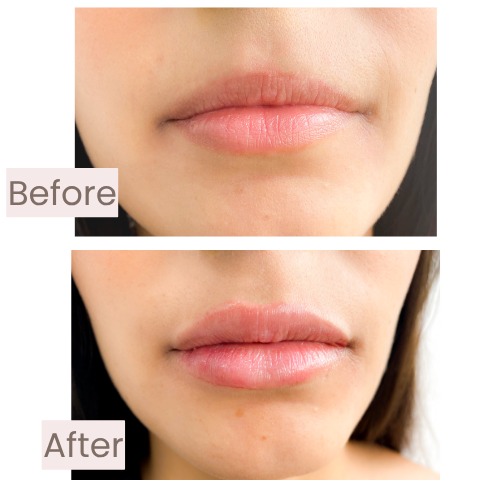 Before and after lip enhancement with facial harmonization