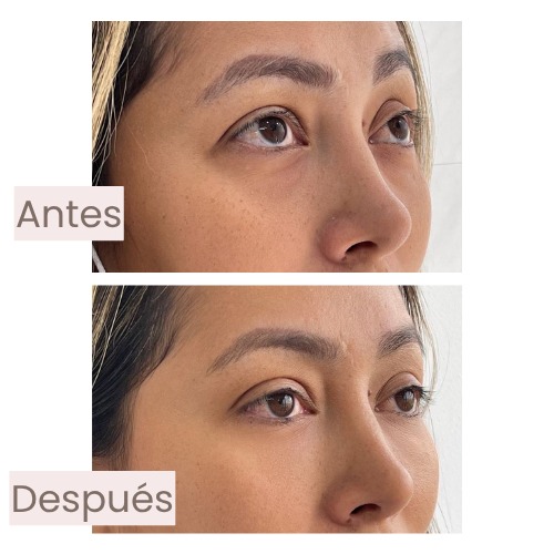 Antes y después de ojeras tratadas con armonización facial