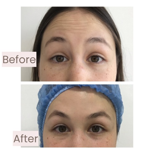 Before and after forehead and glabella treated with facial harmonization