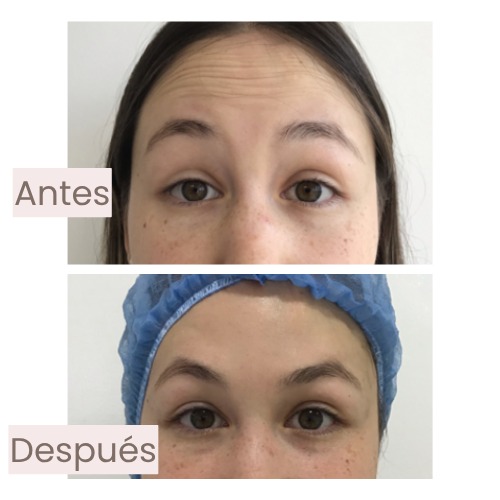 Antes y después de frente y entrecejo tratados con armonización facial