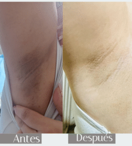 antes y después