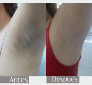 antes y después